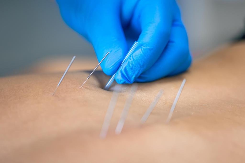Curso de acupuntura: SES oferece vagas para médicos em MT