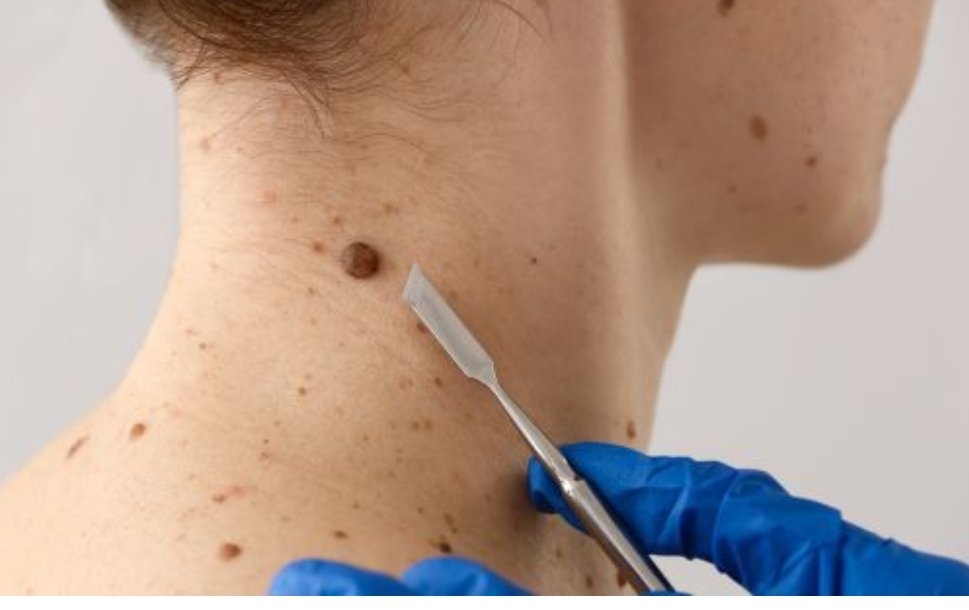 Atendimento dermatológico em Cáceres é ampliado pela Prefeitura