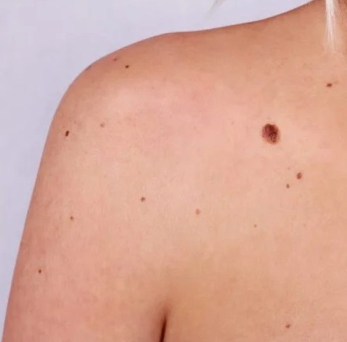 Atendimento dermatológico em Cáceres é ampliado com mutirão