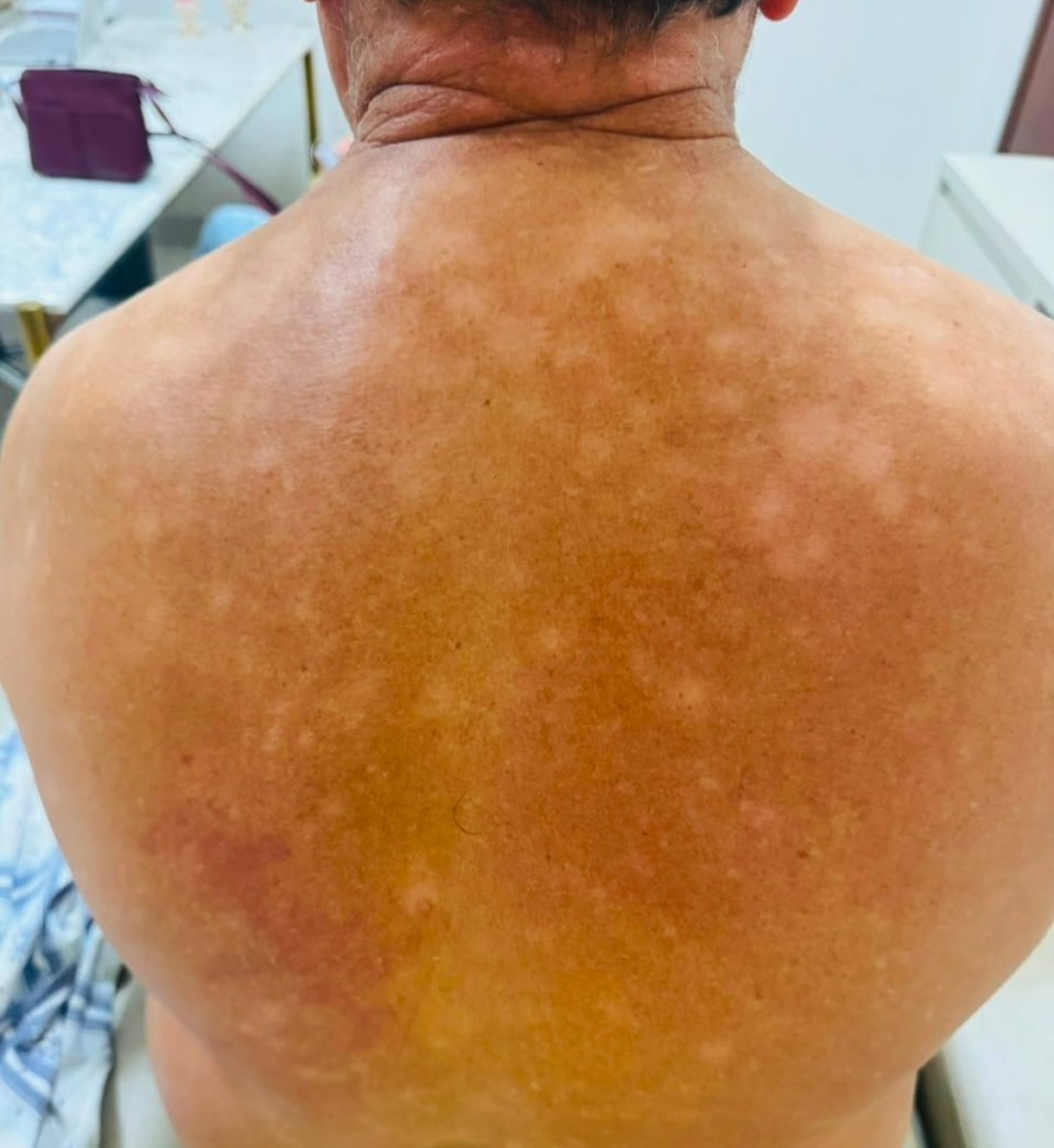 Procedimentos dermatológicos em Cáceres: 100 cirurgias no fim de semana